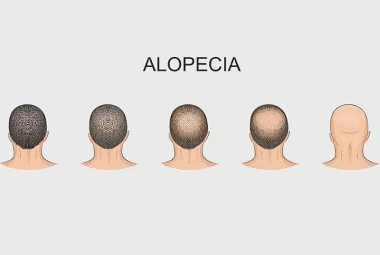 The stages of androgenetic alopecia