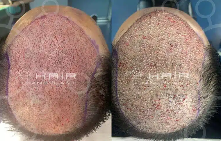 Another mega session was held at the Hair Transplant Clinic.