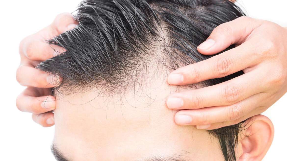 Alopecia areata – causes & treatment methods image