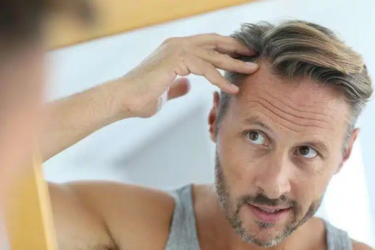 Types of hair loss in men