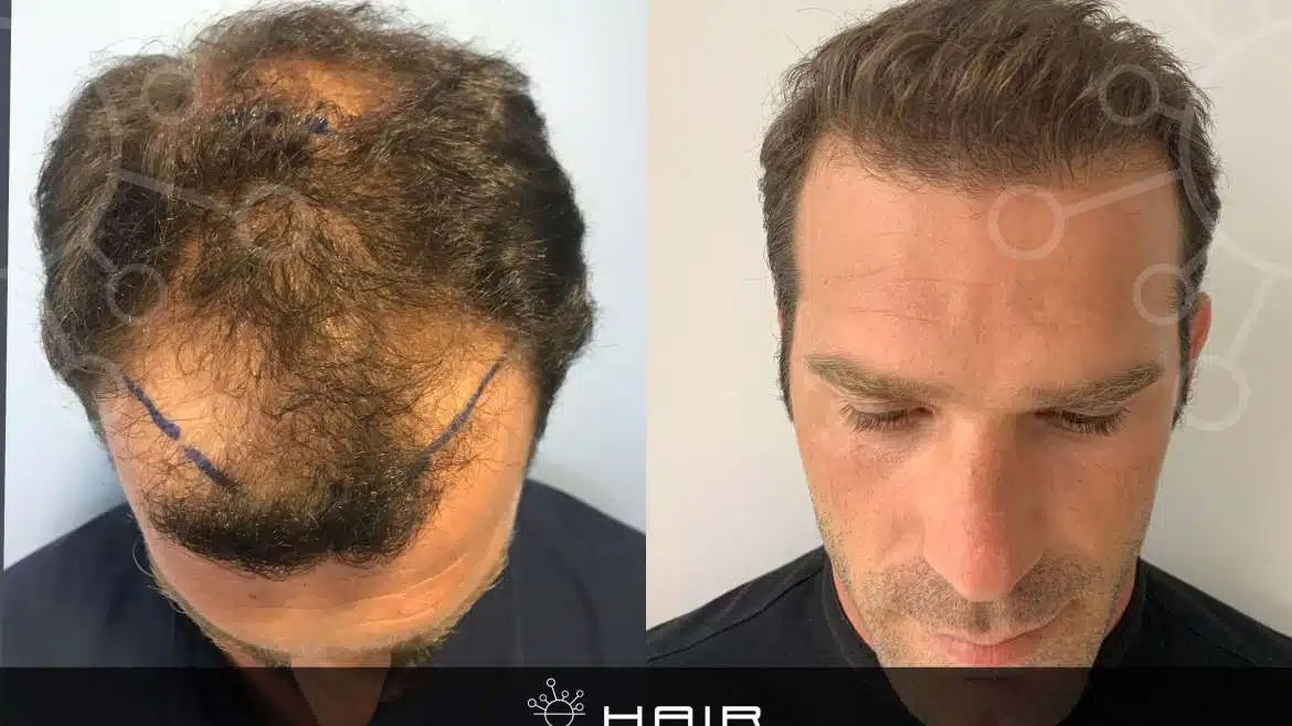 Former Survivor Contestant Underwent Hair Transplant! (Pics + Video)