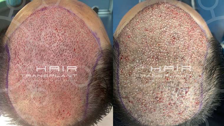 Another mega session was held at the Hair Transplant Clinic. 2,730 grafts with the FUE technique in 8.5 hours!