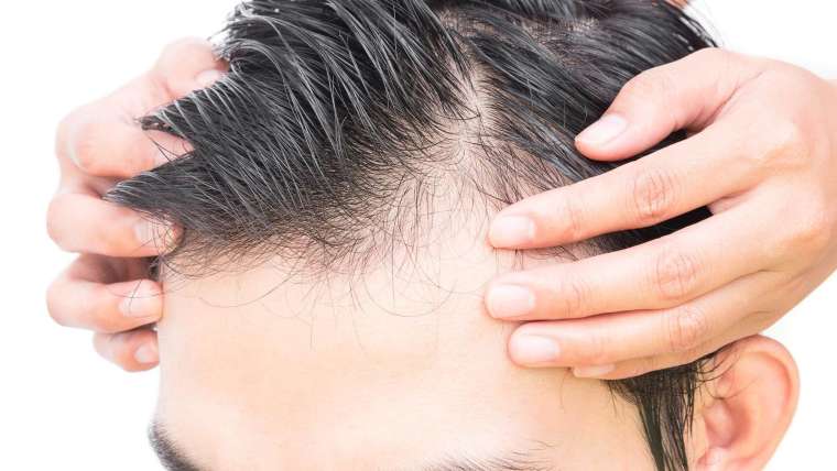 Alopecia areata – causes & treatment methods