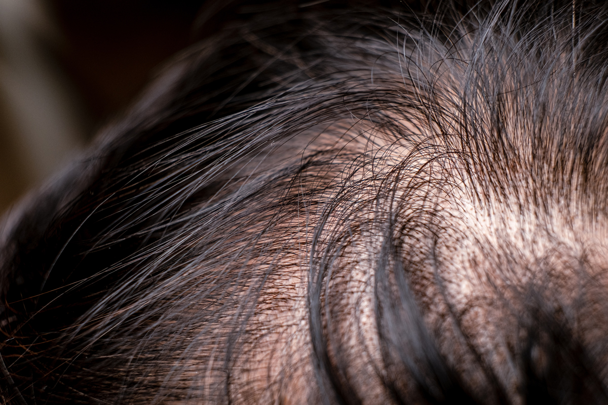 androgennetiki-alopekia-hairtransplant-clini