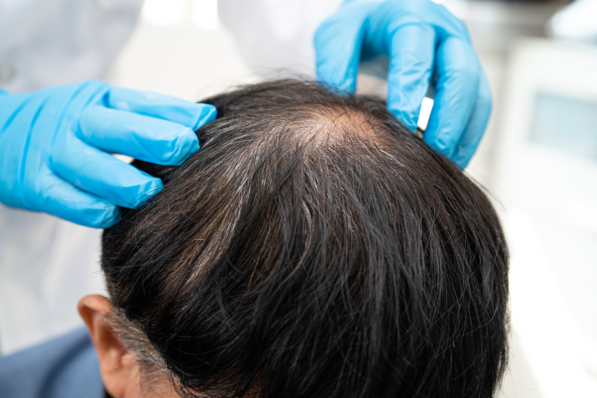 trixoptosi-hairtransplan-clinic