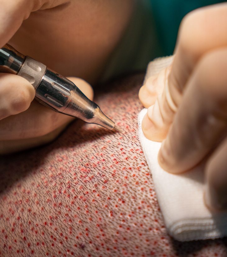 hairtransplant proccess