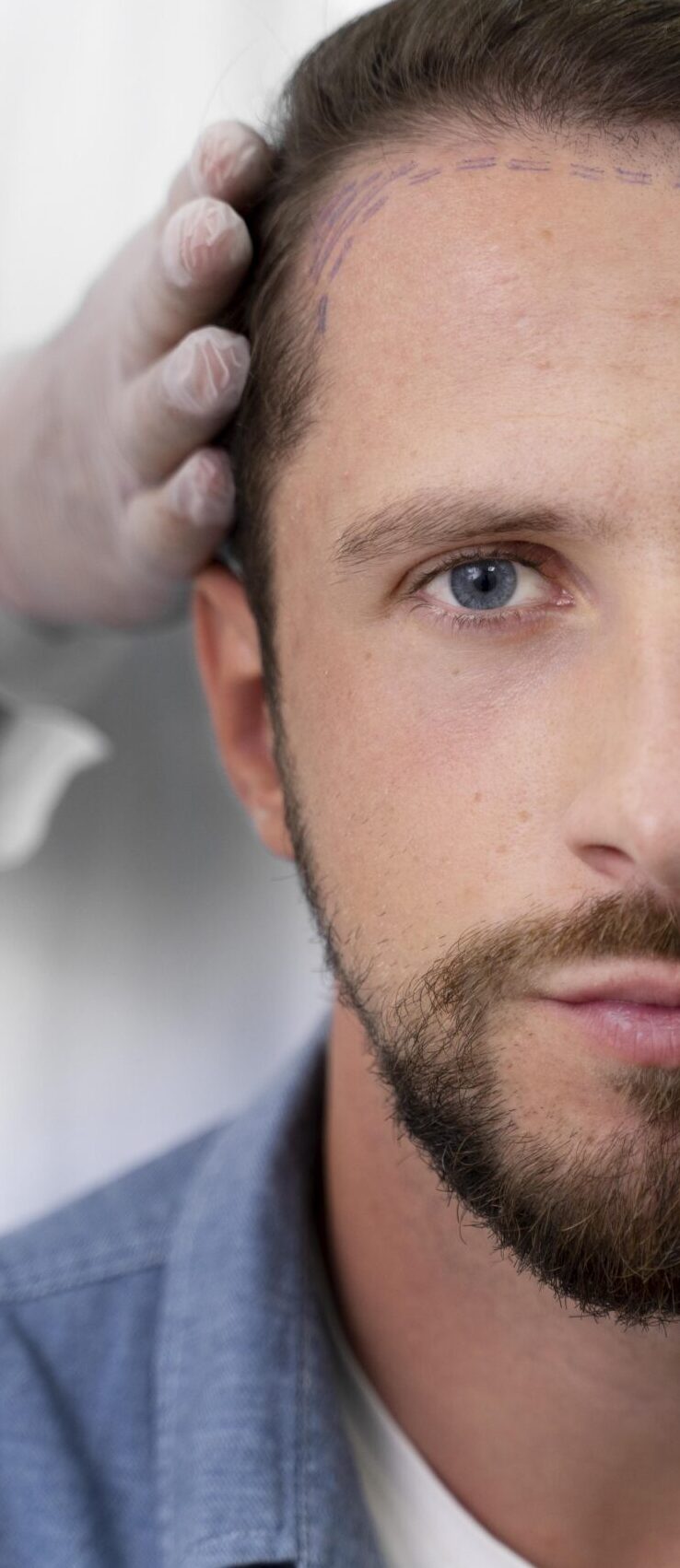 adult-male-doing-follicular-unit-extraction