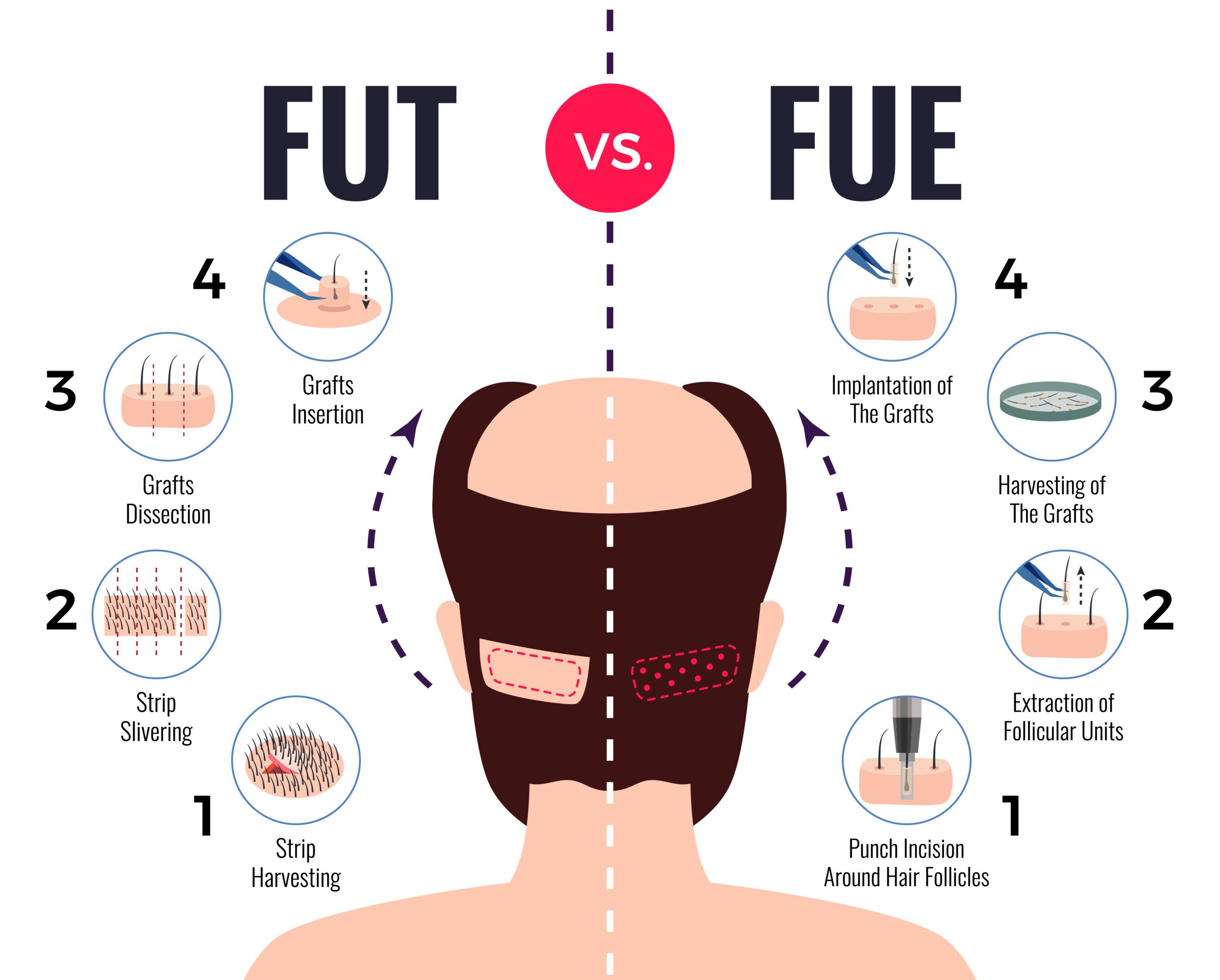 fut vs fue hair transplantation