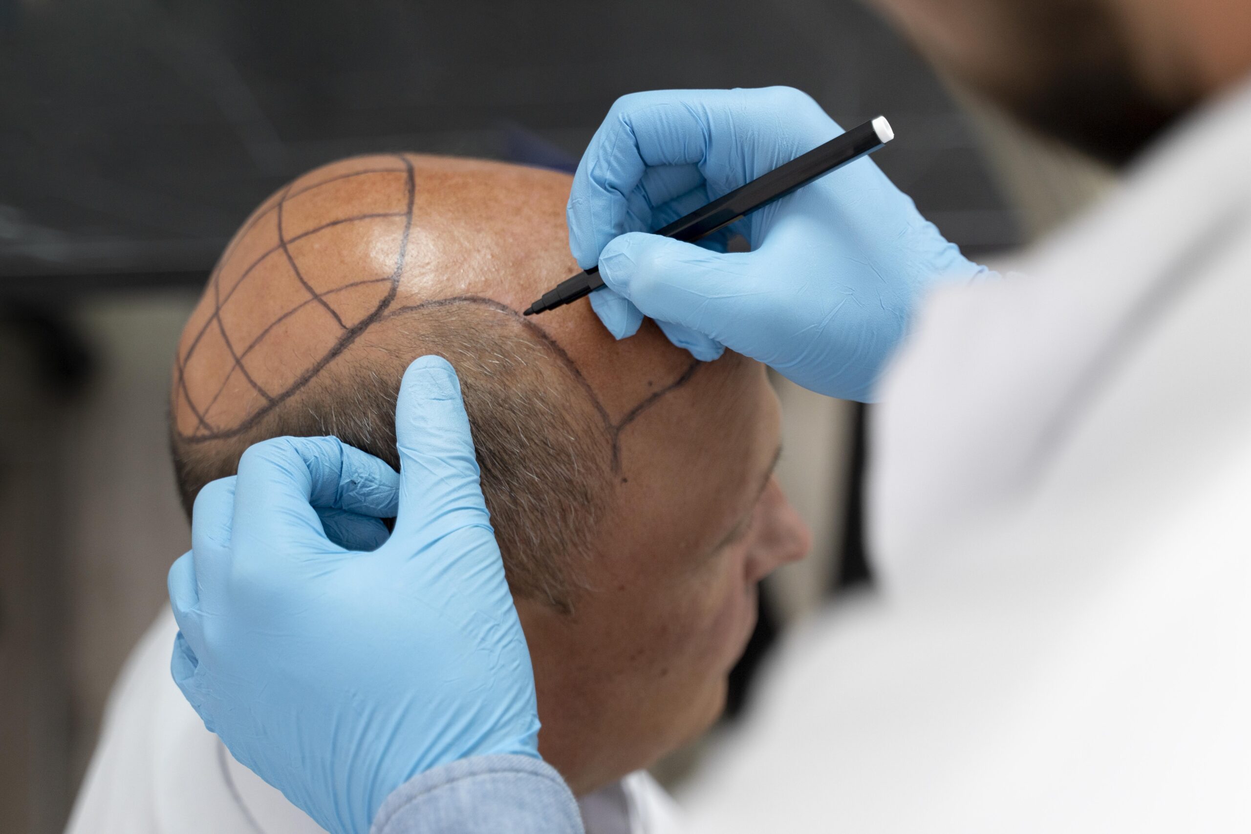 male-going-through-follicular-unit-extraction-process (1)