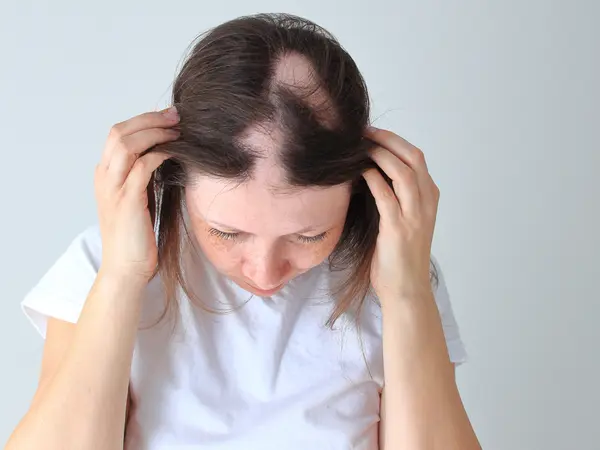 alopekia