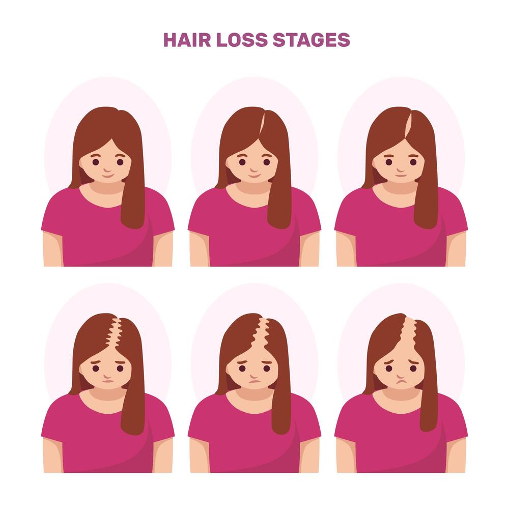 hair loss stages