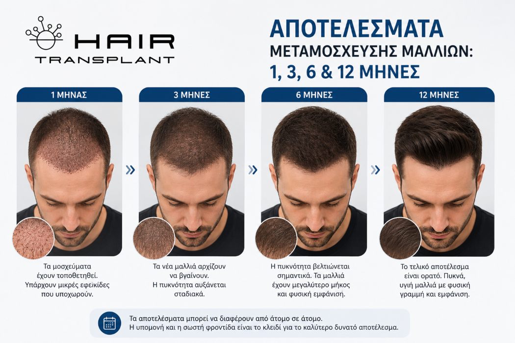 'Αποτελέσματα Μεταμόσχευσης Μαλλιών: 1, 3, 6 & 12 Μήνες' featured image