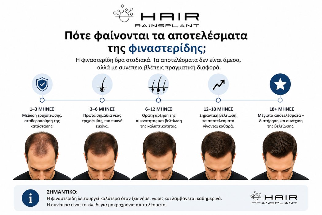 Αποτελέσματα θεραπείας με φιναστερίδη για την τριχόπτωση