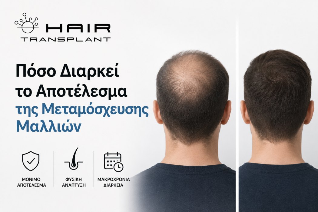 Άνδρας με φυσικό αποτέλεσμα μετά από μεταμόσχευση μαλλιών